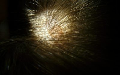 Why do I get scabs on my scalp?